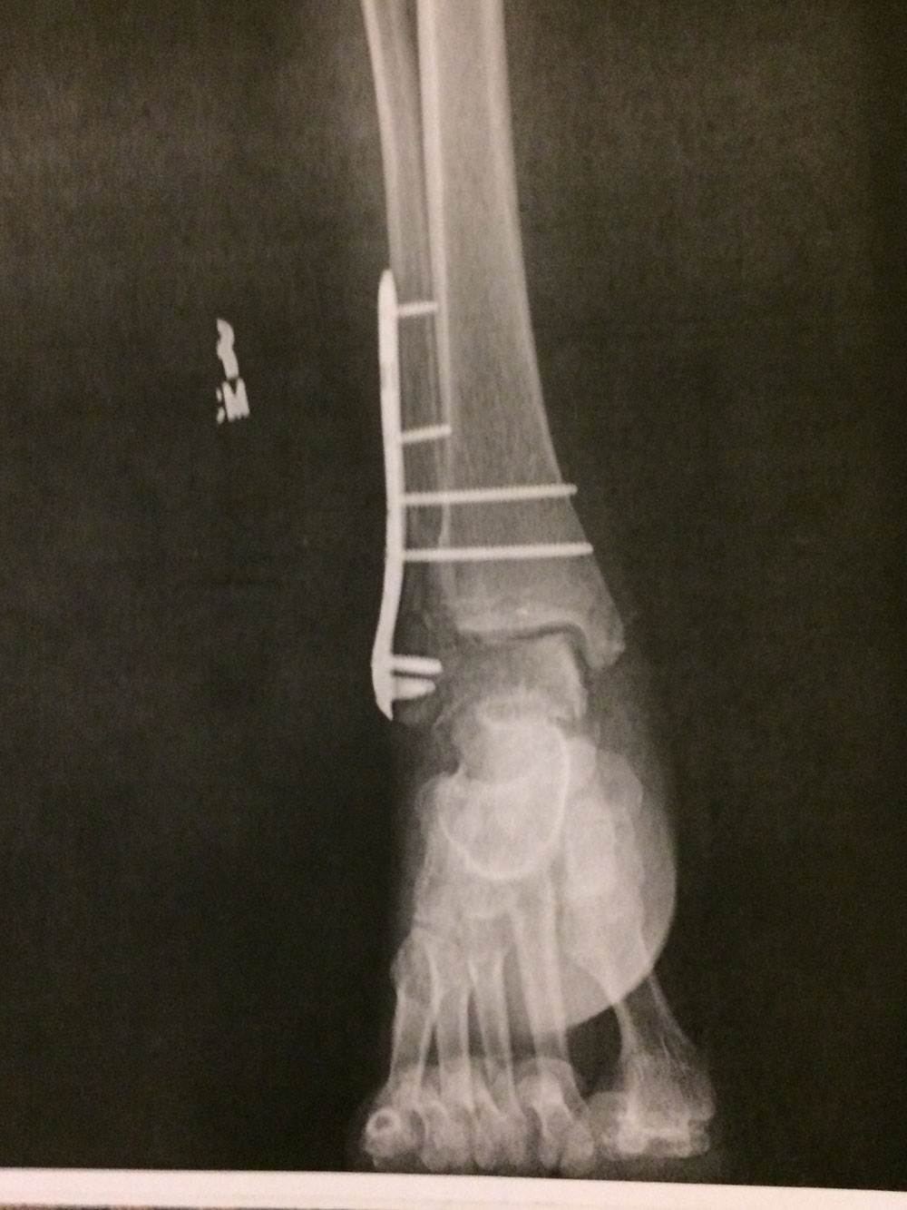 Personal Injury 1
