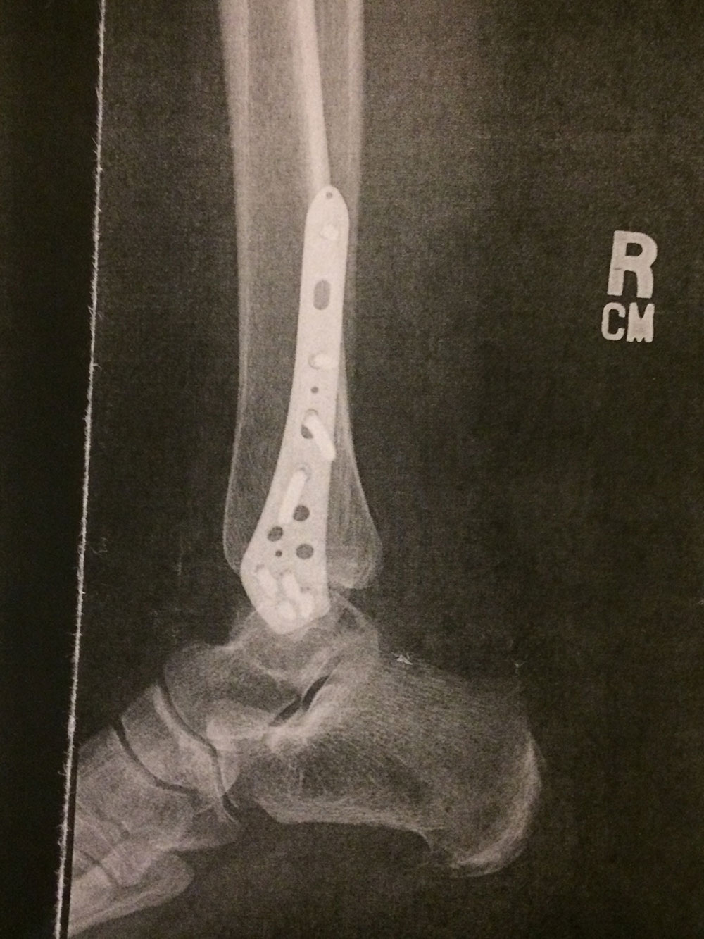 Personal Injury 2