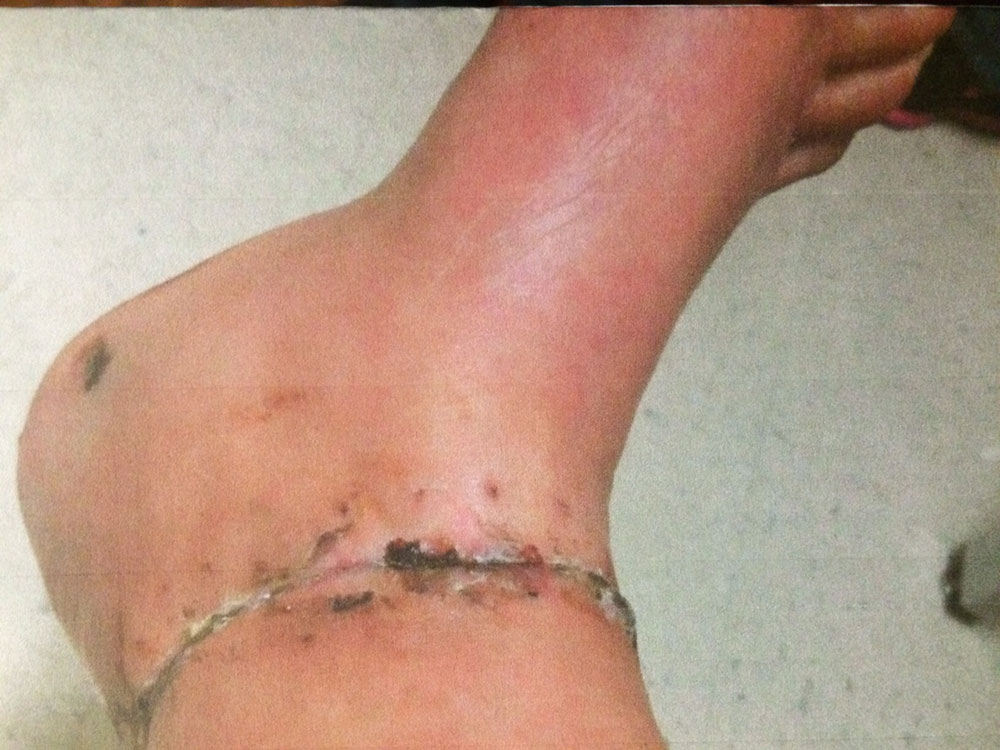 Personal Injury 3
